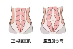 剖宫产后康复及42天内护理